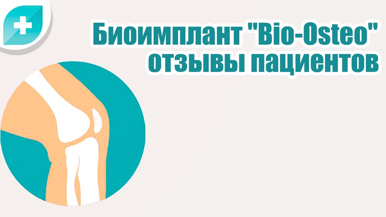 Схема коленного сустава — Биоимплант Bio-Osteo